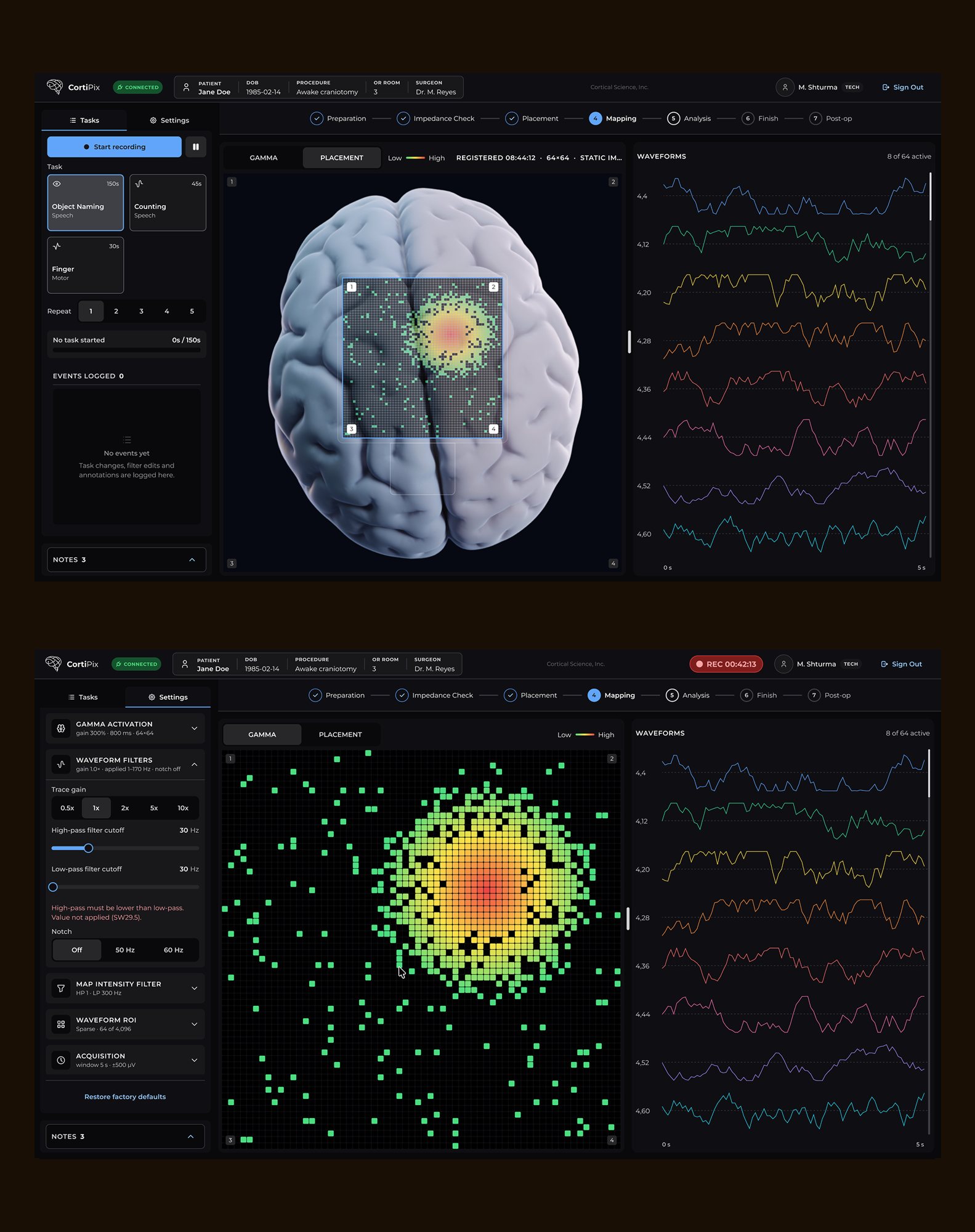 Two mapping screens — a 3D brain with an electrode grid over live signal traces, and below it a dense green activation cloud beside the same traces, carrying a critical alert